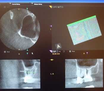 K90003D_screen_view_root_canals_teeth_imaging_Klym