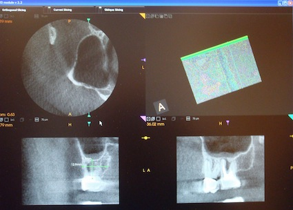 K90003D_screen_view_root_canals_teeth_imaging_Klym