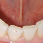 Alva lower teeth before smile makeover