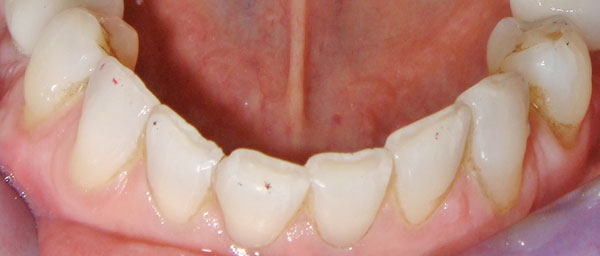 Alva lower teeth before smile makeover