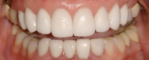 closeup of smile after a smile makeover using veneers