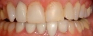 Before veneers makeover