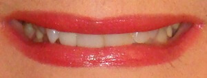 Close up of smile before a smile makeover