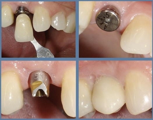 Klym_Dentists_Toms_Sedation_Implants_Collage6