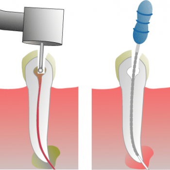 Root Canal Illustration