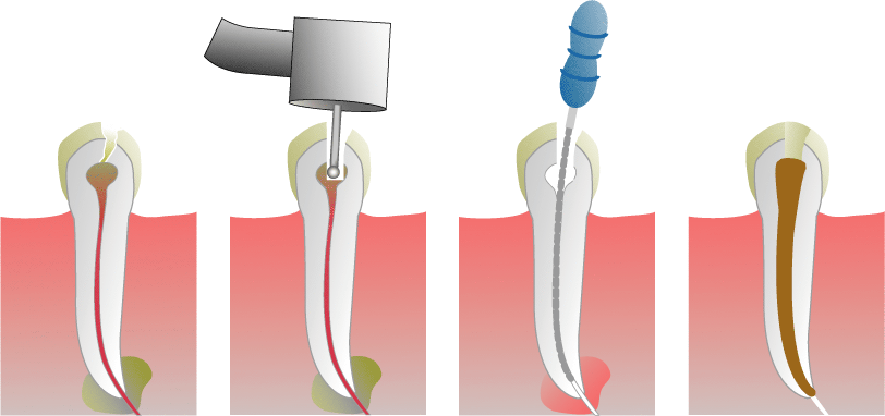 Root Canal Illustration