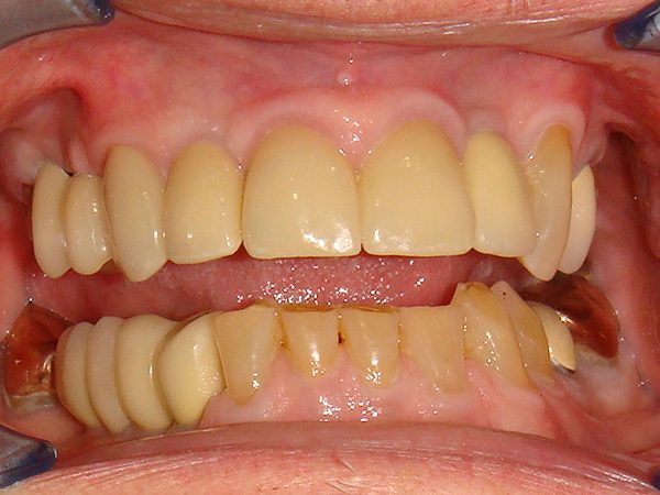 “After” picture of a Northwood Dental patient with a restored smile.