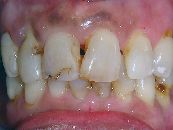 The severely damaged smile of a woman that would later be completely restored by Dr. Klym.