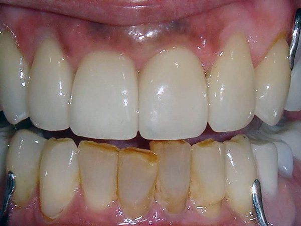 A severely damaged smile that has been partially restored by Dr. Klym at Northwood Dental.