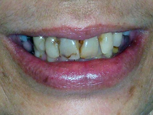 Severely damaged smile before the patient received cosmetic treatment at Northwood Dental.