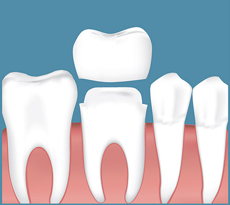 Porcelain Dental Crown