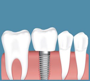 Graphic of a dental Implant between two teeth