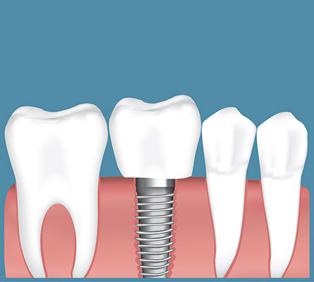 Dental Implant