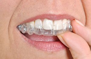 Invisalign Braces Fit