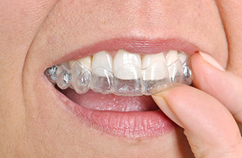 Invisalign Braces Fit