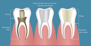 Root Canal Example