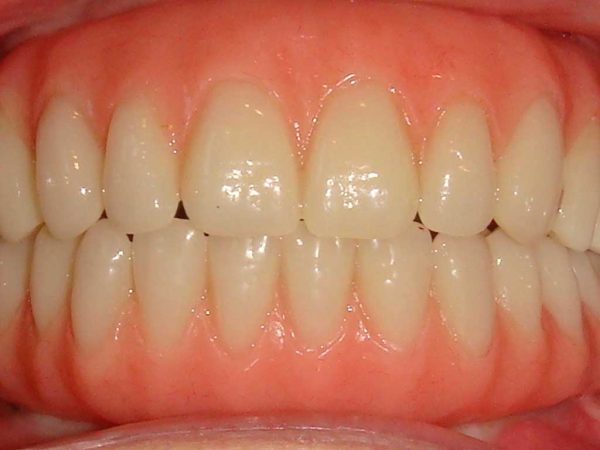 Teeth in a day after image, closeup