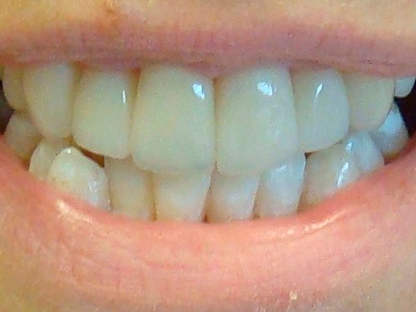 Closeup of a Northwood Dental patient showing off an attractive restored smile