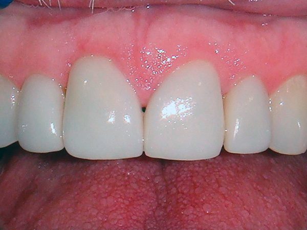 “After” picture of the beautifully restored smile of a patient at Northwood Dental.