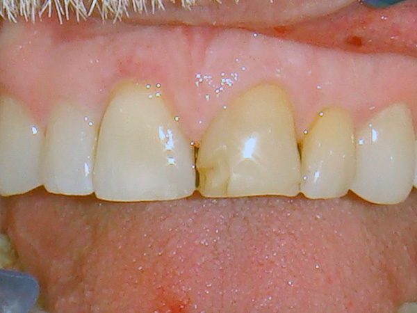 Smiling patient with a front tooth that’s marred by a surface crater.