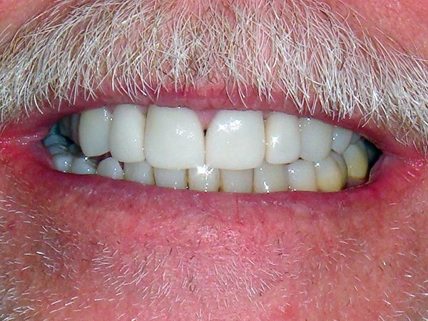 “After” picture of the attractive bright smile of a male patient at Northwood Dental.