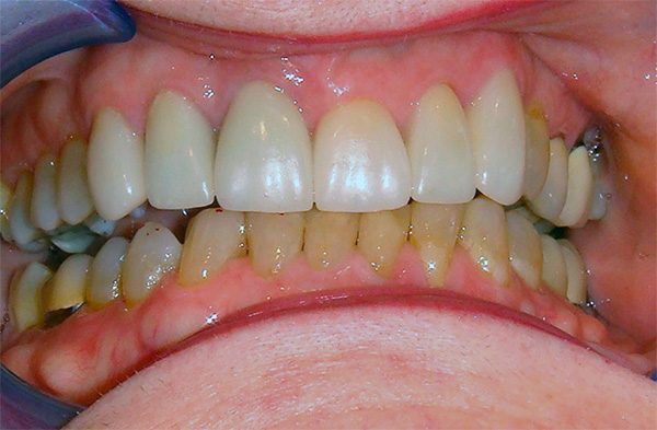 Closeup of a Northwood Dental patient with a restored smile, case 5