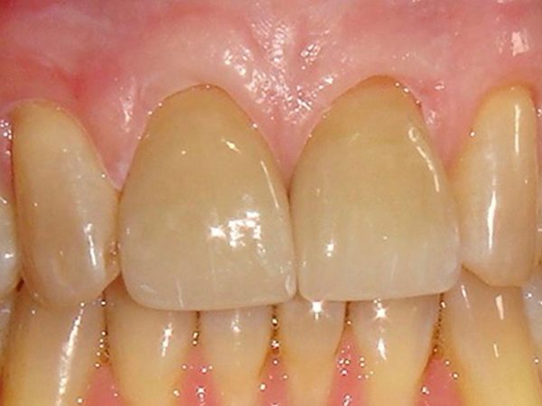 After picture of a patient whose smile was cosmetically restored by Dr. Klym at Northwood Dental.