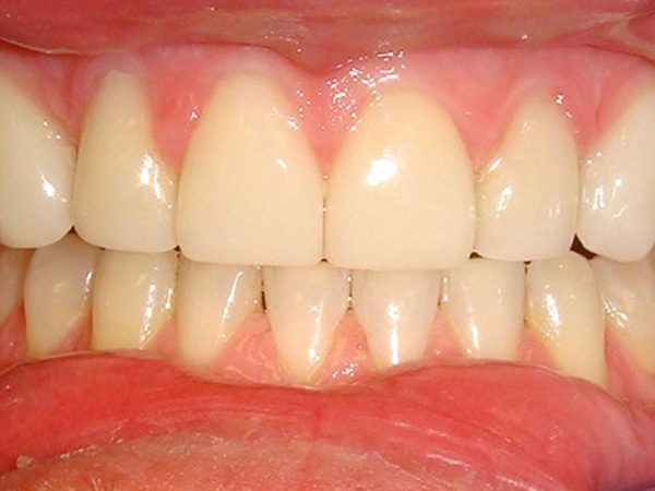 “After” closeup of a patient with an attractive smile restored by Dr. Klym.