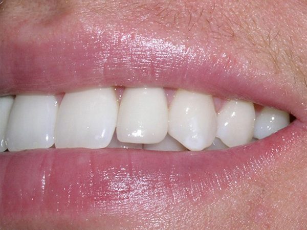 “After” closeup of a man’s smile that was cosmetically restored by Dr. Klym using dental implants and veneers.