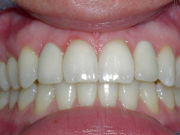 “After” closeup of a man’s smile that was cosmetically restored by Dr. Klym using dental implants and veneers.