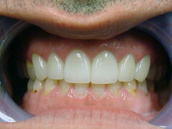 Closeup of implant patient at Northwood Dental.