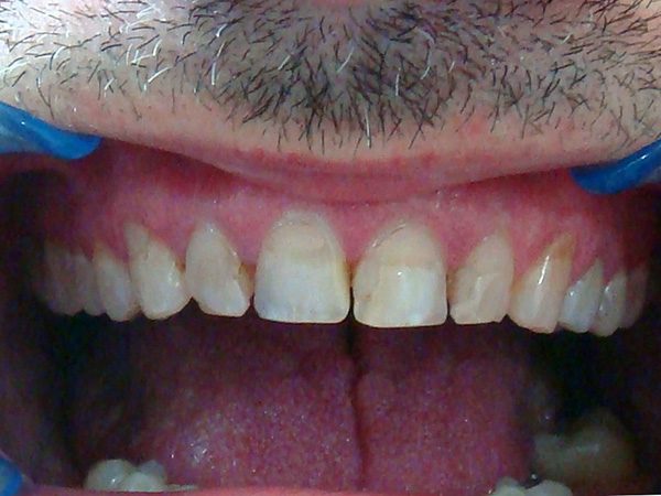 Before picture of a patient whose smile was restored by Dr. Klym.