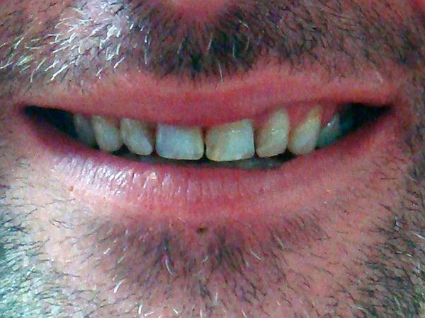 Case 15 before smile restoration