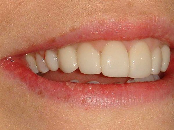 The attractive smile of a female patient that has been restored by Dr. Klym, case 16