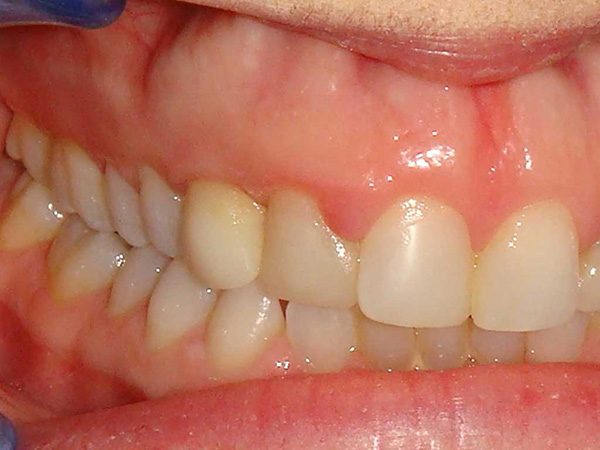 “Before” picture of a smile that was later restored by Dr. Klym using cosmetic procedures.