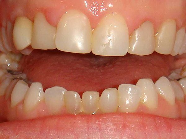 Closeup of a “before” picture of a smile that was restored by Dr. Klym at Northwood Dental.