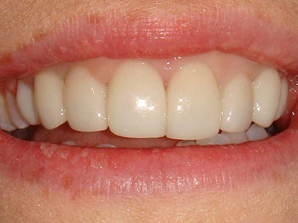 Closeup picture of a smile after restoration by Dr. Klym at Northwood Dental.