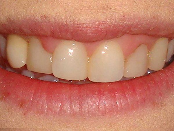 Closeup picture of a smile before it was restored by Dr. Klym at Northwood Dental.