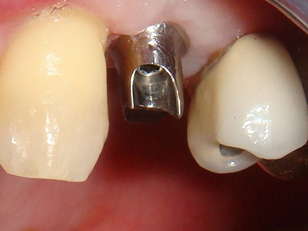 dental implant fixture