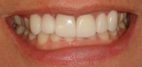 “After” picture of the attractive smile of a female patient at Northwood Dental.