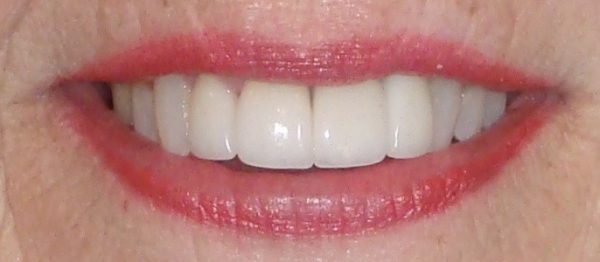 Closeup of a woman’s smile that Dr. Klym restored using Invisalign, new crowns, and veneers.