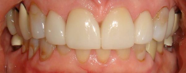 “After” closeup of a cosmetic patient with a restored smile from Northwood Dental.