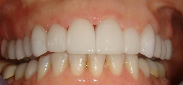 Closeup of a Northwood Dental patient with a restored smile