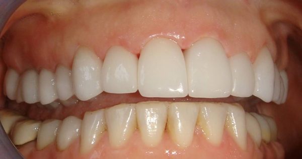 “After” closeup of a smile that was cosmetically restored by Dr. Klym using crowns and veneers.