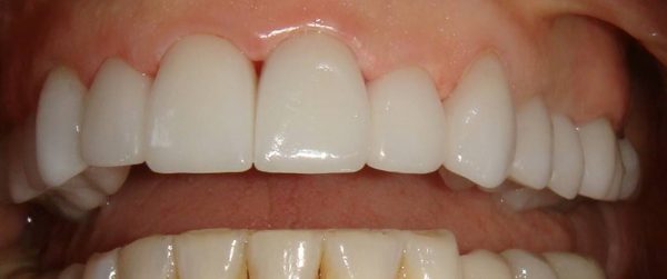 “After” picture of a smile restored by Dr. Klym