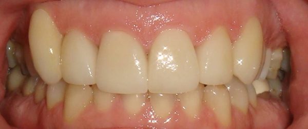 “After” photo of Northwood Dental patient who got a smile makeover and instant orthodontics.