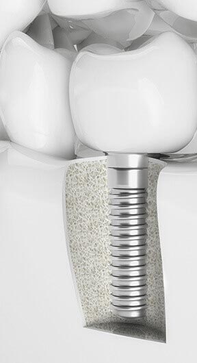 implant fixture